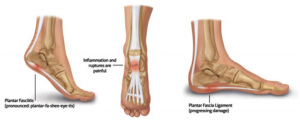 Plantar Fascilitis